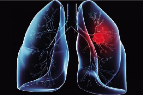 肺结核的传播途径主要是什么 肺结核的早期能治好吗
